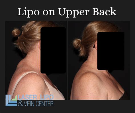  Cannot be combined with any other deals, offers, or promotions. . Bra bulge liposuction cost